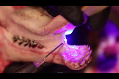 Tongue Tie Procedure/ Frenectomy Using S1 PIOON 450 Wavelength Laser