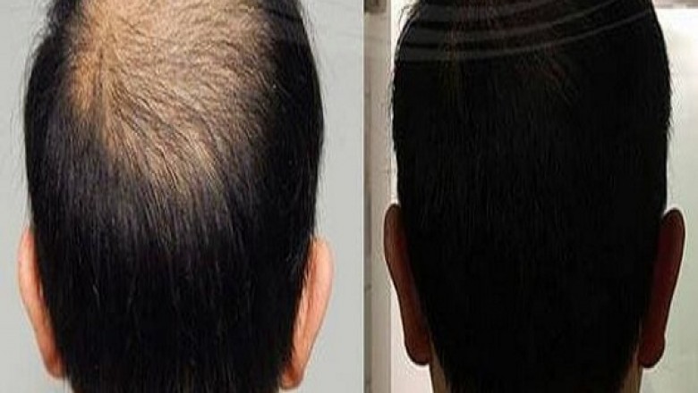Hair Bonding in Bangalore