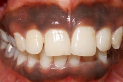 Gingival Depigmentation with Dental Lasers for Management of Gingival Hyperpigmentation