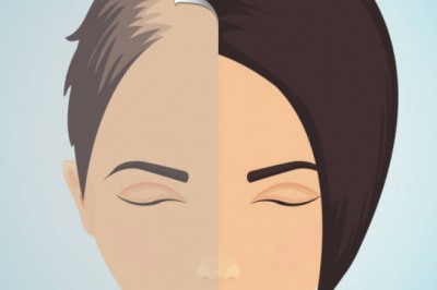 Hair Loss Treatment in London