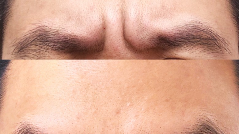 Do You Really Know What Botox Is?