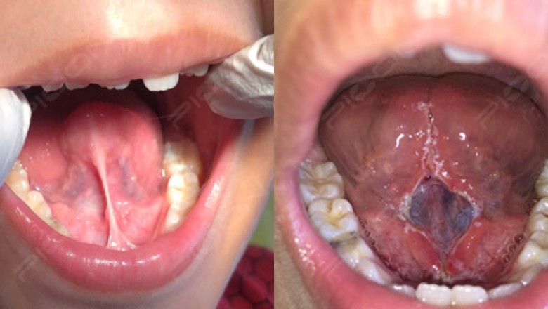 Management of Tongue-Tie/Ankyloglossia - A Surgical Procedure with Dental Laser