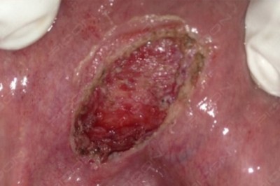 How to treat oral mucous cysts