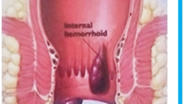 Best treatment for piles / Haemorrhoidectomy in NewDelhi, India