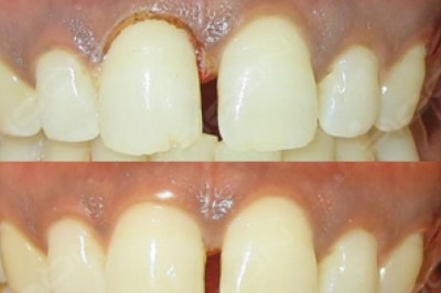 Gingivoplasty Using Diode Laser