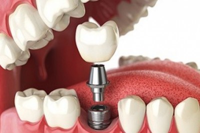 Dental Biomaterial Market is projected to grow at CAGR 7.41%