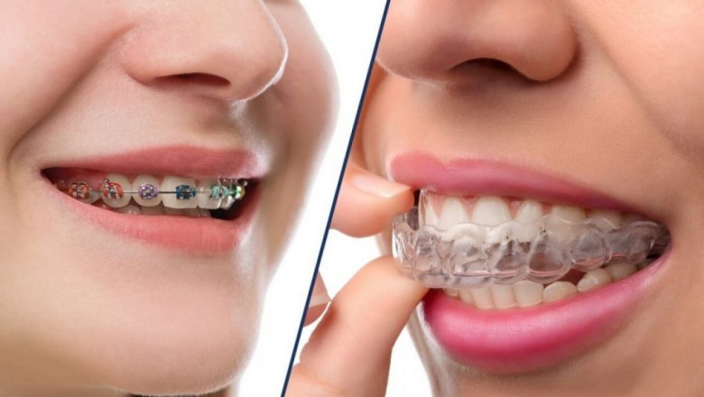 Invisalign Dentists - Discrete Teeth Straightening