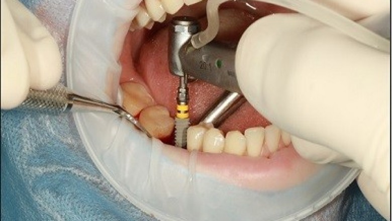 Dental Biomaterial Market Trend-Ensuring Efficacious Oral Care