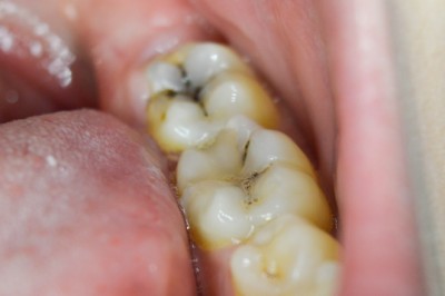 What Do You Do When Advised Cavity Treatment By Your Dentist