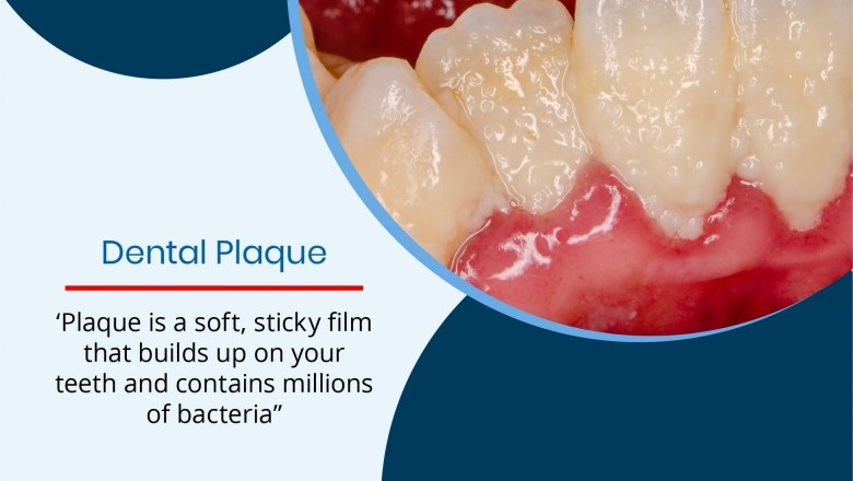 Dental Plaque | 24 Hour Emergency Dentists