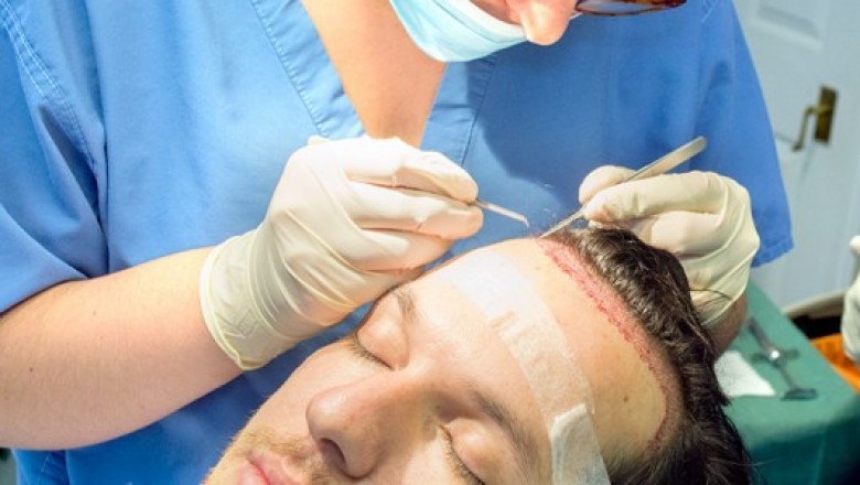 Hair Transplant: What To Know And How Does It Works?