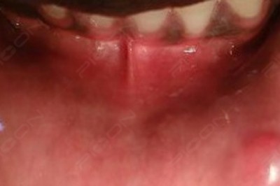 Excision of Fibroma using Dental Soft-tissue Diode Laser