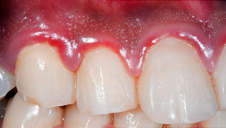 Periodontal Treatment Necessary When You Are Affected by Gum Disease