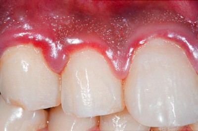 Periodontal Treatment Necessary When You Are Affected by Gum Disease