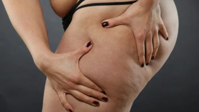 Know The Procedure To Remove Fat