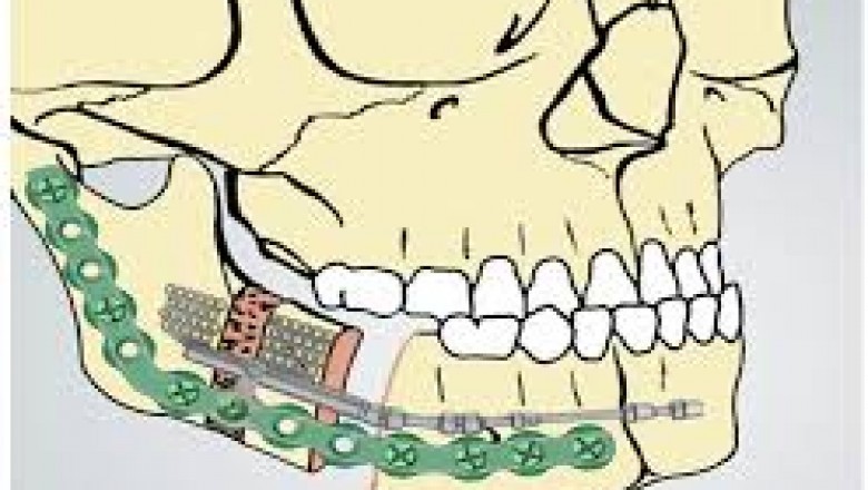Overview of Distraction Osteogenesis Devices Market