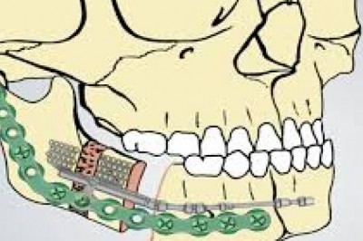 Overview of Distraction  Osteogenesis Devices Market