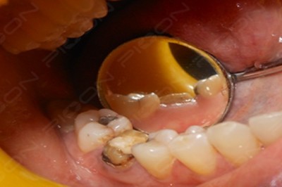 Crown Lengthening Procedure using Dental Diode Laser