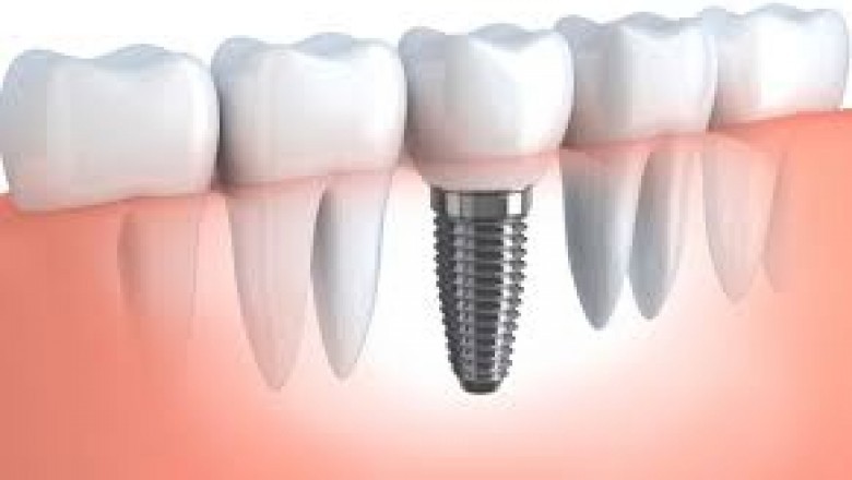 Dental Implant Replacement Treatment