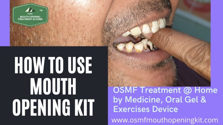 Osmf Mouth Opening treatment Kit Releases Video Showing How to Use the Mouth Opener DIY Kit at Home