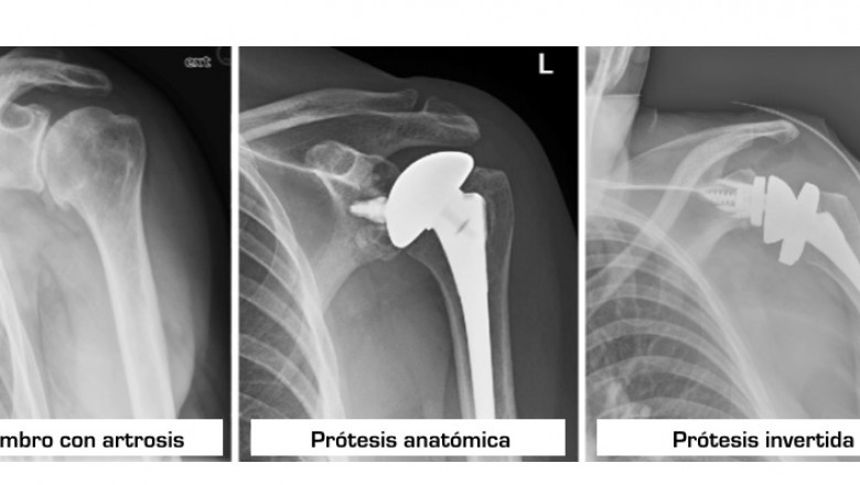 Reverse Total Shoulder Replacement