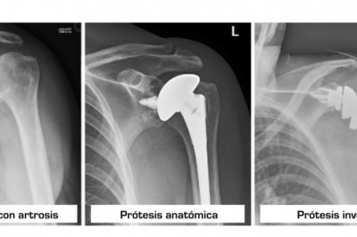 Reverse Total Shoulder Replacement