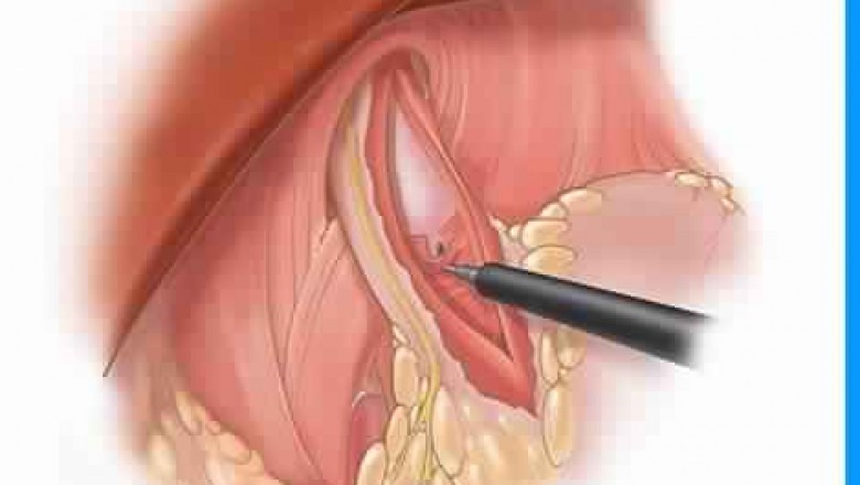 Laparoscopic surgery of Achalasia Cardia