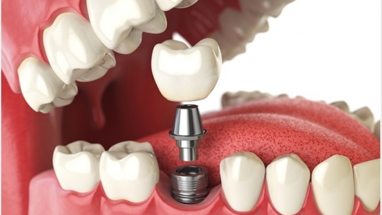 Full Mouth Dental Implants