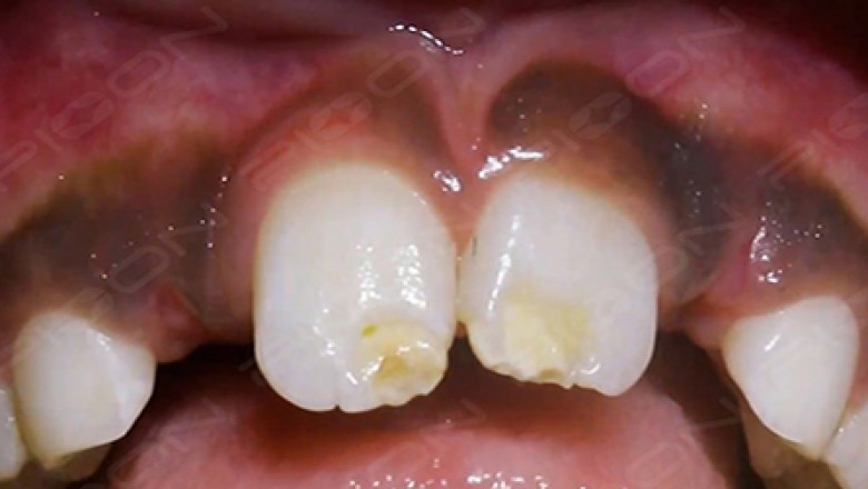 Management of Unerupted Lateral Incisor by LASER Assisted Surgical Exposure