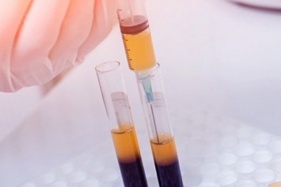 Global Platelet Rich Plasma Market is Witness Massive Surge as U.S.-based Industry Leader Generex Biotechnology Corporation acquires Medisource Partners