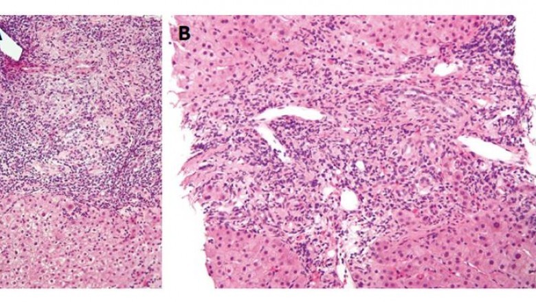 High Prevalence of Primary Biliary Cholangitis and Approval and Launch of New Drugs to Augment Growth of Primary Biliary Cirrhosis Drug Market