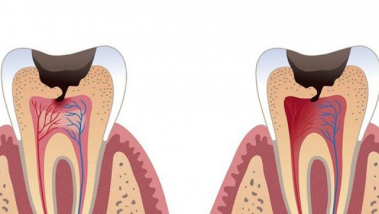 Dental Caries Market Size, Share, Outlook, and Opportunity Analysis, 2018– 2026