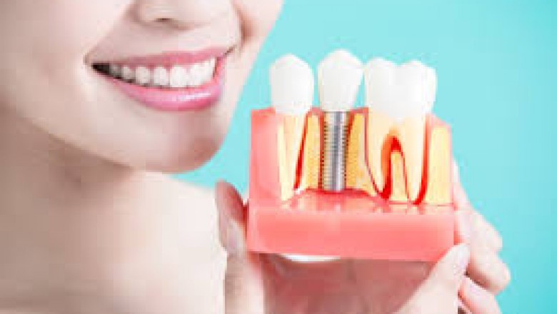 What is a dental implant and how much does it cost?