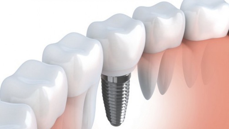Osseointegration Implants Market Size Share Trends Forecast 2026
