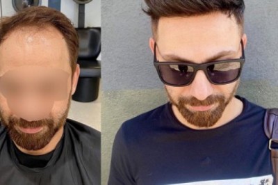 Under What Circumstances Will We Wear Non-surgical Hair