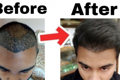 Best Hair Transplant in Delhi - Chandra Clinic