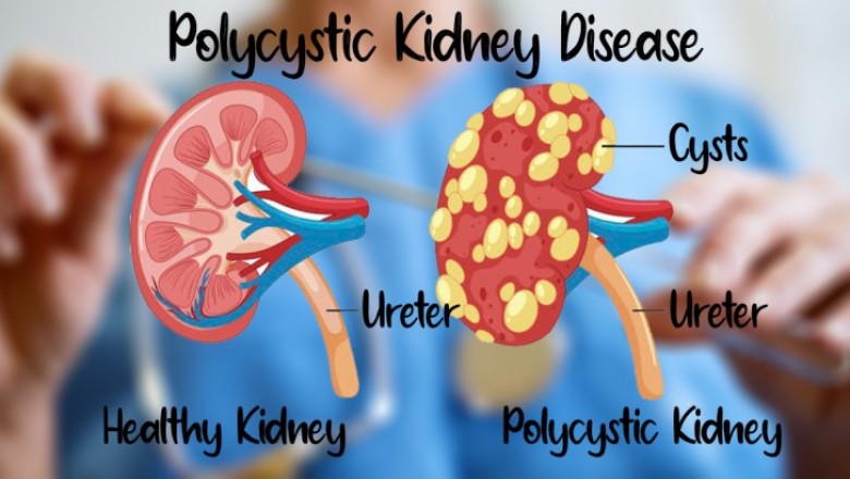 Natural Remedies for Polycystic Kidney Disease and Healthy Diet