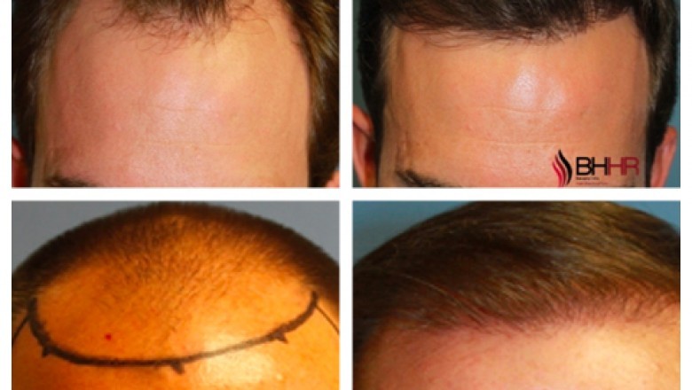 Fue Hair Transplants