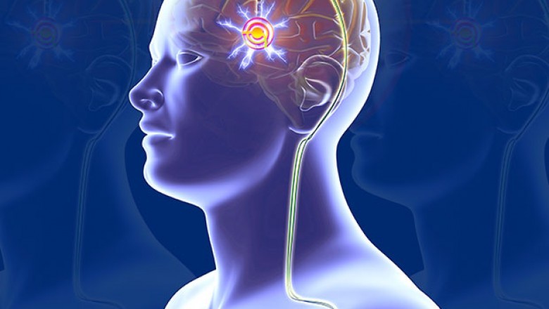 Increasing Prevalence of Parkinson’s Disease and Approval and Launch of New Products to Augment Growth of Deep Brain Stimulation Devices Market