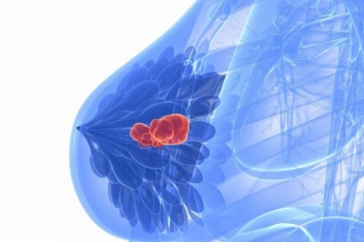 Breast Imaging Market To Surpass US$ 7,287.1 Million By 2026 - Coherent Market Insights
