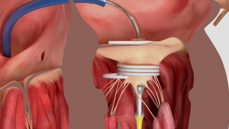 Reparation and reconstruction of the transcatheter mitral valve and an emerging invasive procedure play an important role in improving heart health