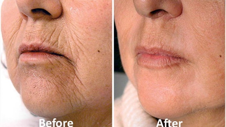 Laser Skin Tightening - How To Prepare And What To Expect