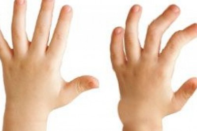 Treatment of Hunter Syndrome; Depends on age and severity of condition