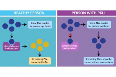 Many Studies Show that Dietary Modification is the Most Efficient and Appropriate Treatment choice for Phenylketonuria.