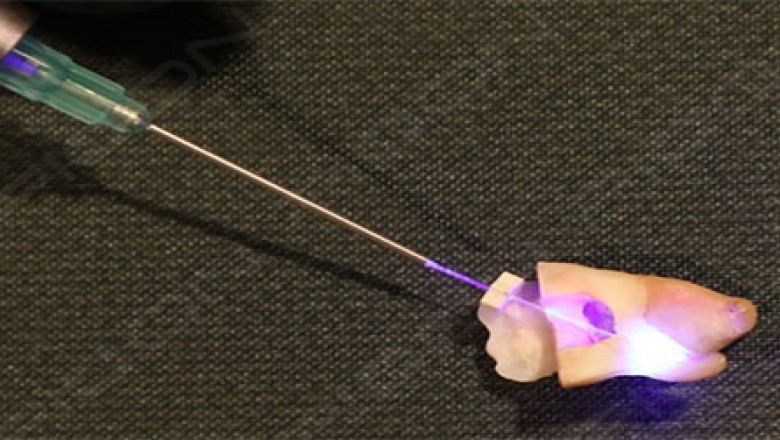 Root Canal Disinfection in Primary Molar During Pulpectomy Procedure using S1 PIOON LASER