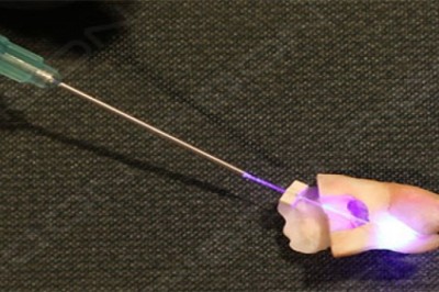 Root Canal Disinfection in Primary Molar During Pulpectomy Procedure using S1 PIOON LASER