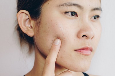 How To Prevent Cheek Acne?