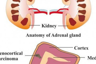 Novel adrenocortical carcinoma treatment options are significantly safer and more effective, enabling patients with faster recovery