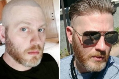 What Everyone Should Know About Non-surgical Hair!