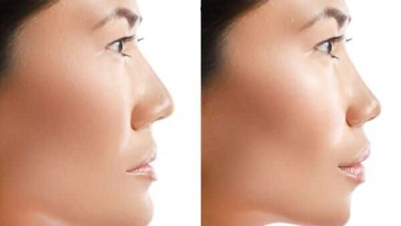 Broken and Defective Jaw Surgery in Charlotte NC